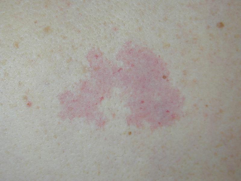 Download Angioma (800Wx600H)