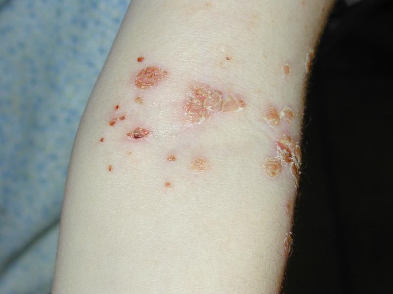 Download Impetigo braccio (800Wx600H)