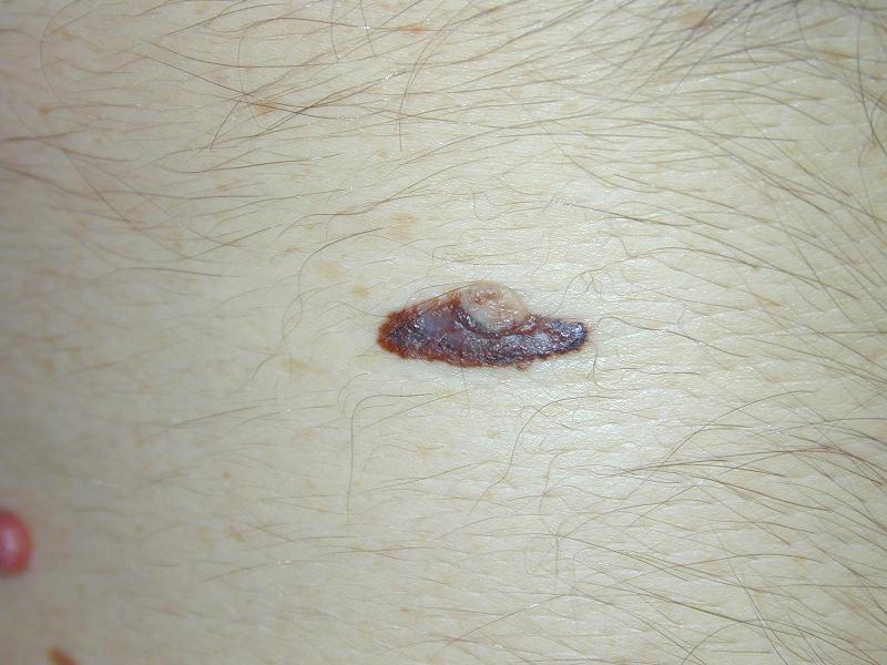 Download Melanoma (800Wx600H)