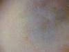Nevo blu dermatosc. (800Wx600H) - Nevo blu alla dermatoscopia. Cortesia di Emilio Sani, dermatologo a Collecchio (PR).<br> Per concessione di www.listaippocrate.it: atlante dermatologico 