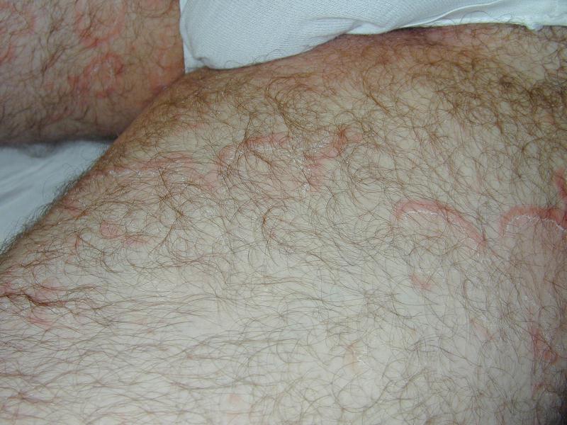 Download Tinea corporis (800Wx600H)