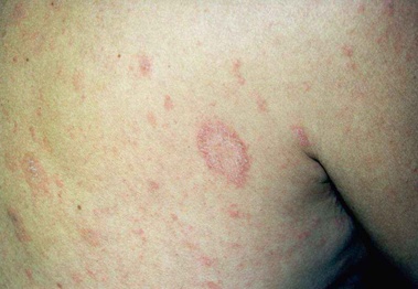 Download Pitiriasi rosea (379Wx262H)