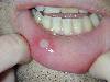 Afta (800Wx600H) - Afta del labbro inferiore. Cortesia di Emilio Sani, dermatologo a Collecchio (PR).<br> Per concessione di www.listaippocrate.it: atlante dermatologico 