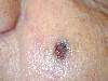 Basalioma (800Wx600H) - Basalioma del volto. Cortesia di Emilio Sani, dermatologo a Collecchio (PR).<br> Per concessione di www.listaippocrate.it: atlante dermatologico 