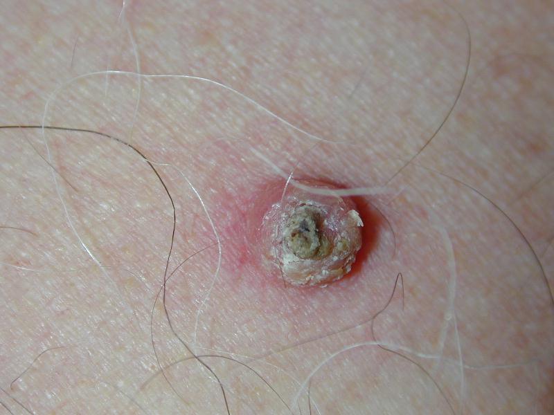 Download Cheratoacantoma (800Wx600H)