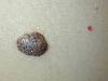 Cheratosi seborroica (800Wx600H) - Cheratosi seborroica. Cortesia di Emilio Sani, dermatologo a Collecchio (PR).<br> Per concessione di www.listaippocrate.it: atlante dermatologico 