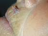 Corno cutaneo (800Wx600H) - Corno cutaneo. Cortesia di Emilio Sani, dermatologo a Collecchio (PR).<br> Per concessione di www.listaippocrate.it: atlante dermatologico 