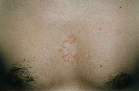 Download Dermatite seborroica (540Wx354H)