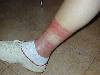 Dermatite contatto (800Wx600H) - dermatite allergica da contatto della gamba. Cortesia di Emilio Sani, dermatologo a Collecchio (PR).<br> Per concessione di www.listaippocrate.it: atlante dermatologico 