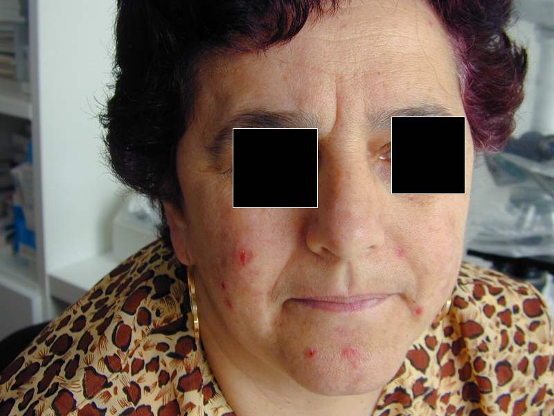 Download Dermatite factitia (800Wx600H)