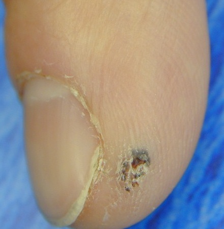 Download Emangioma (440Wx449H)