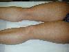 Eritema ab igne (800Wx600H) - Eritema ab igne. Cortesia di Emilio Sani, dermatologo a Collecchio (PR).<br> Per concessione di www.listaippocrate.it: atlante dermatologico 
