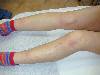 Eritema nodoso (800Wx600H) - Eritema nodoso arti inferiori. Cortesia di Emilio Sani, dermatologo a Collecchio (PR).<br> Per concessione di www.listaippocrate.it: atlante dermatologico 