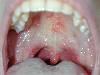 Erpangina (800Wx600H) - Erpangina da virus Coxackie. Cortesia di Emilio Sani, dermatologo a Collecchio (PR).<br> Per concessione di www.listaippocrate.it: atlante dermatologico 