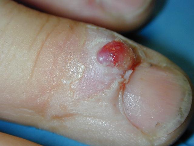Download Granuloma piogenico (640Wx480H)