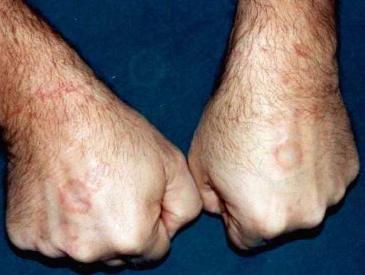 Download Granuloma anulare (513Wx386H)