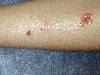 Impetigo gamba (800Wx600H) - Impetigo della gamba. Cortesia di Emilio Sani, dermatologo a Collecchio (PR).<br> Per concessione di www.listaippocrate.it: atlante dermatologico 