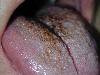 Lingua nigra (640Wx480H) - Lingua nigra villosa. Cortesia di Emilio Sani, dermatologo a Collecchio (PR).<br> Per concessione di www.listaippocrate.it: atlante dermatologico 