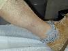 Lyme malattia di (800Wx600H) - Malattia di Lyme eritema cronicum migrans. Cortesia di Emilio Sani, dermatologo a Collecchio (PR).<br> Per concessione di www.listaippocrate.it: atlante dermatologico 