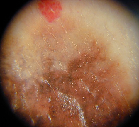 Download Melan diff. sup derm (474Wx433H)