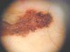 Melanoma dermatosc. (800Wx600H) - Melanoma alla dermatoscopia. Cortesia di Emilio Sani, dermatologo a Collecchio (PR).<br> Per concessione di www.listaippocrate.it: atlante dermatologico 
