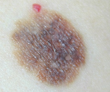 Download Melanoma superfic. (423Wx357H)