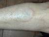 Necrobiosi lipoidea (800Wx600H) - Necrosibiosi lipoidea. Cortesia di Emilio Sani, dermatologo a Collecchio (PR).<br> Per concessione di www.listaippocrate.it: atlante dermatologico 