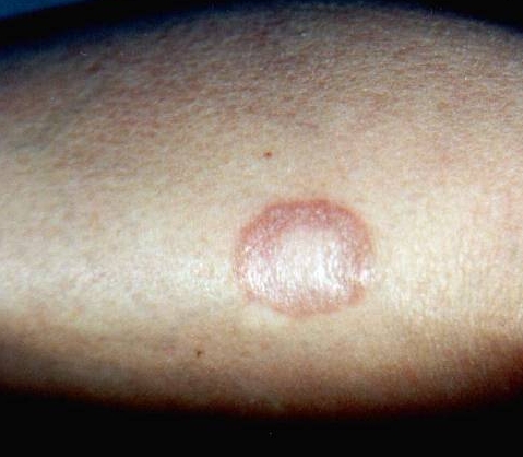 Download Necrobiosi lipoidea (479Wx418H)