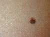 Nevo melanocitico (800Wx600H) - Nevo melanocitico composito. Cortesia di Emilio Sani,<br> dermatologo a Collecchio (PR). Per concessione di www.listaippocrate.it: atlante dermatologico 
