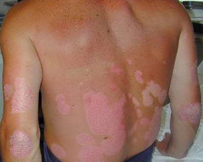 Download Psoriasi (415Wx332H)