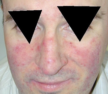 Download Rosacea (436Wx379H)