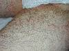Tinea corporis (800Wx600H) - Tinea corporis. Cortesia di Emilio Sani, dermatologo a Collecchio (PR).<br> Per concessione di www.listaippocrate.it: atlante dermatologico 