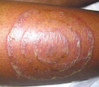 Download Tinea circinata (344Wx304H)
